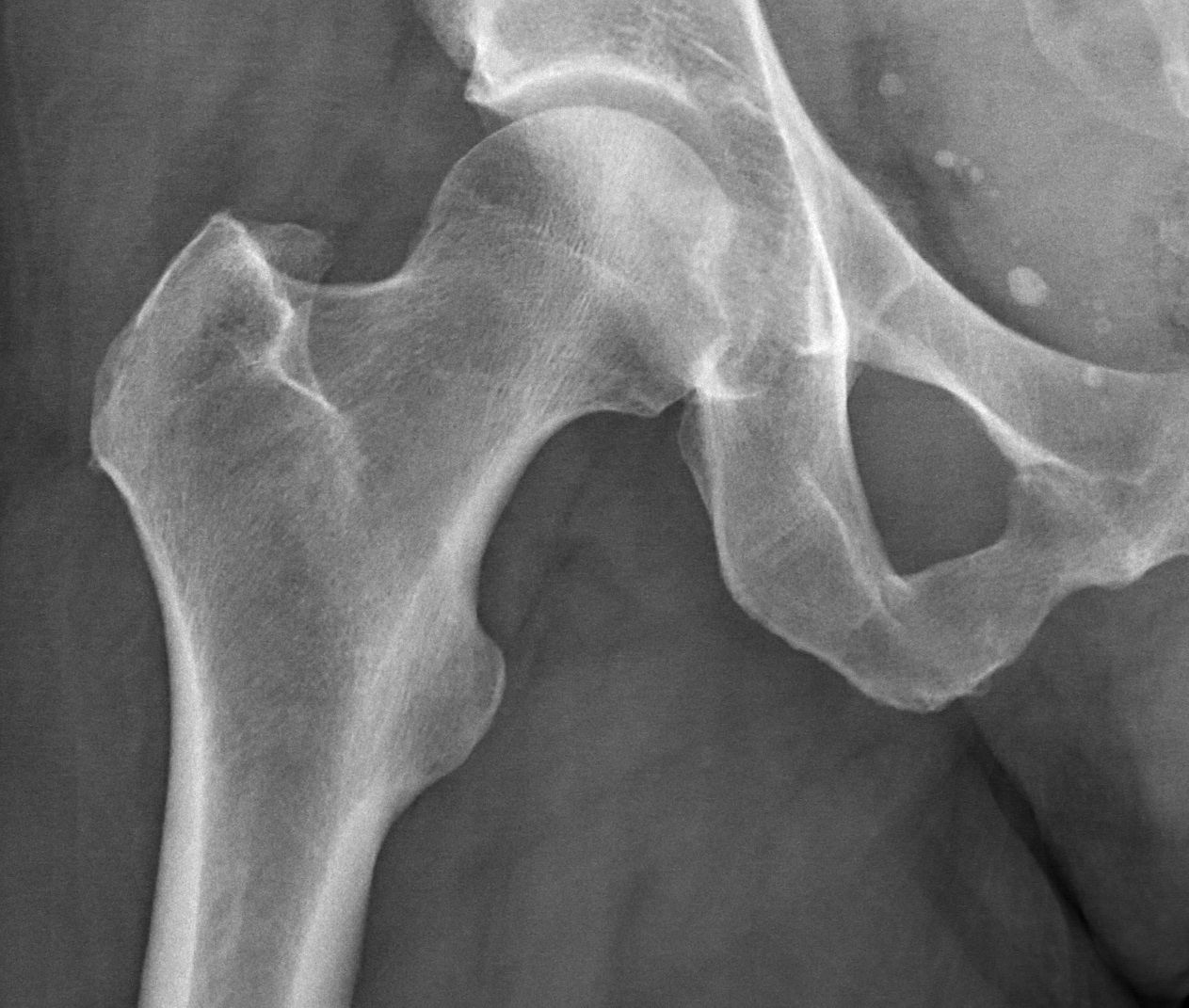 A plain X ray of a healthy adult hip joint showing the femoral head and pelvis, a Wikimedia Commons photograph in the encyclopedia of Candace Cooley