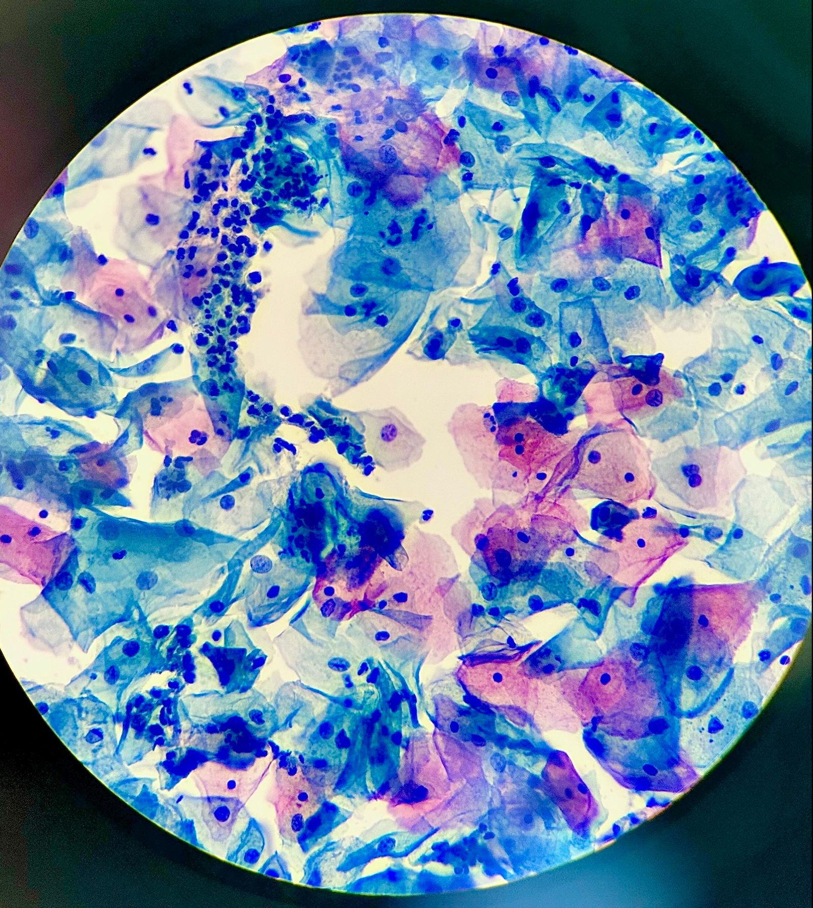 Superficial and intermediate squamous cells in a cervical cytology smear under the microsc, a Wikimedia Commons photograph in the encyclopedia of Candace Cooley